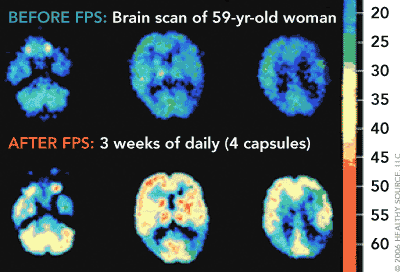 PET image of a 59-year-old female’s brain. The color scale indicates regional glucose metabolism at
                       three brain levels, red is most intense and tertiary is least. Upper: before Flavay Plus; Lower:
                       after Flavay Plus daily for three weeks.